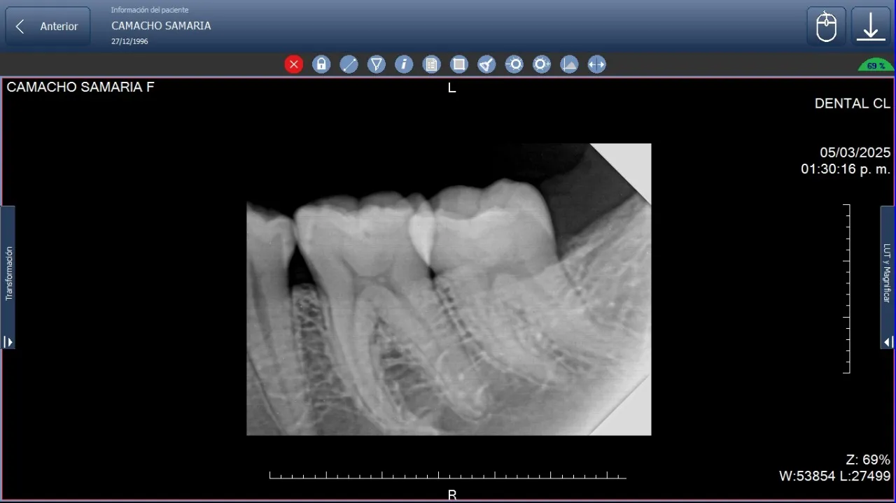 Monitor mostrando una radiografía periapical digital con claridad, demostrando las ventajas del rayos X digital frente al 
               convencional en odontología.